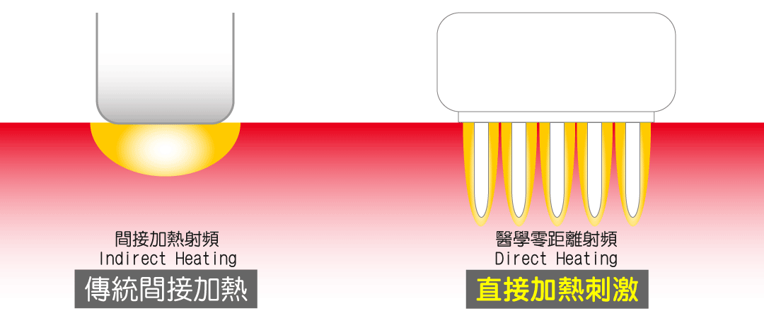 電波拉皮直接加熱與間接加熱比較圖表