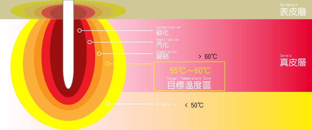 威傲電波拉皮治療溫度表