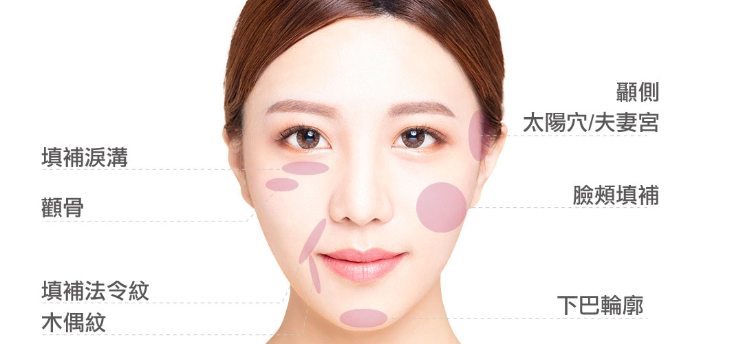 舒顏萃Sculptra(3D聚左旋乳酸)童顏針適用部位