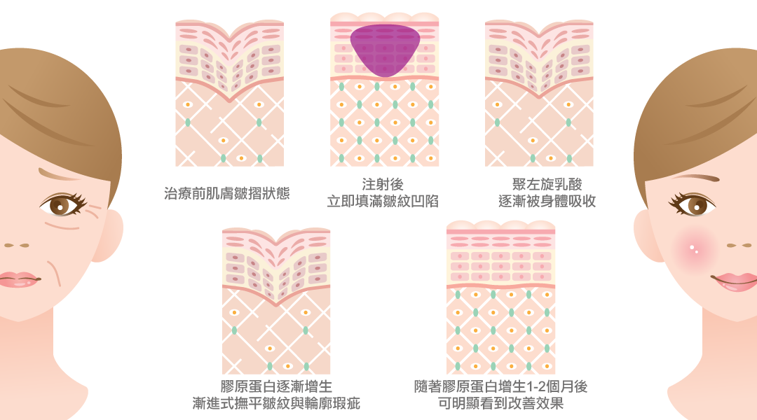 舒顏萃Sculptra(3D聚左旋乳酸)童顏針作用過程