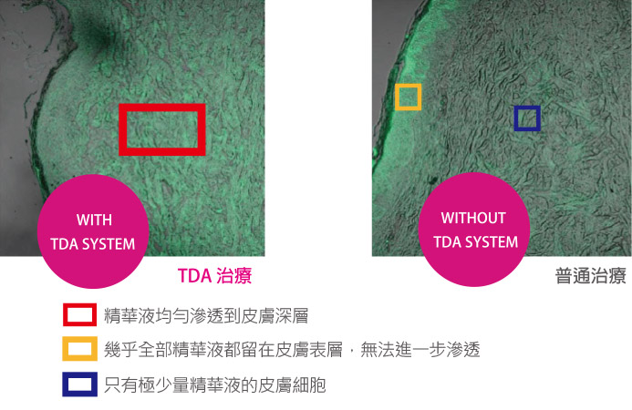 無針水光TDA治療