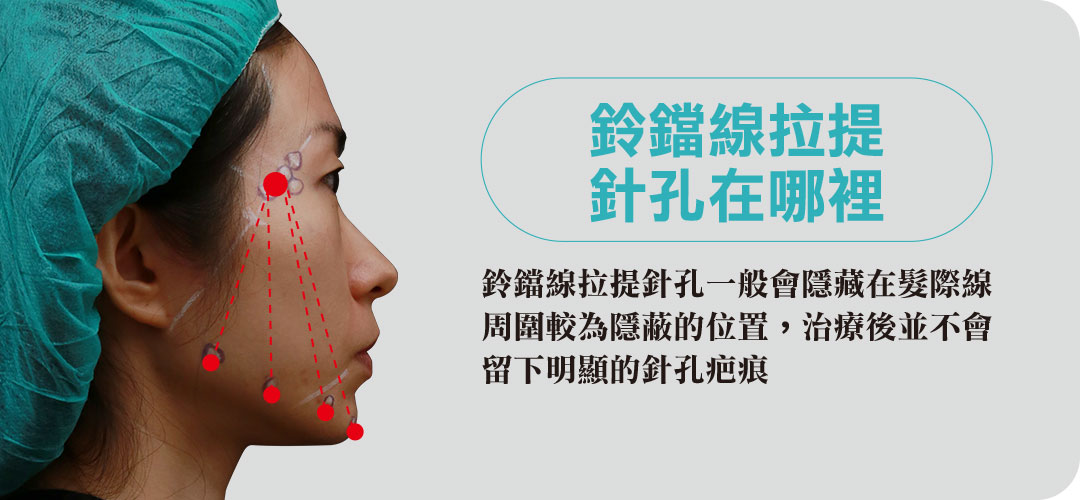 鈴鐺線拉提針孔在哪裡?會留下疤痕嗎? 鈴鐺線拉提針孔在哪裡?會留下疤痕嗎?