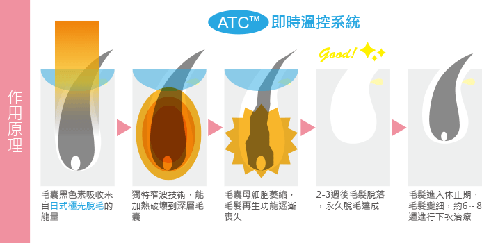 日式極光除毛作用原理-腋下除毛
