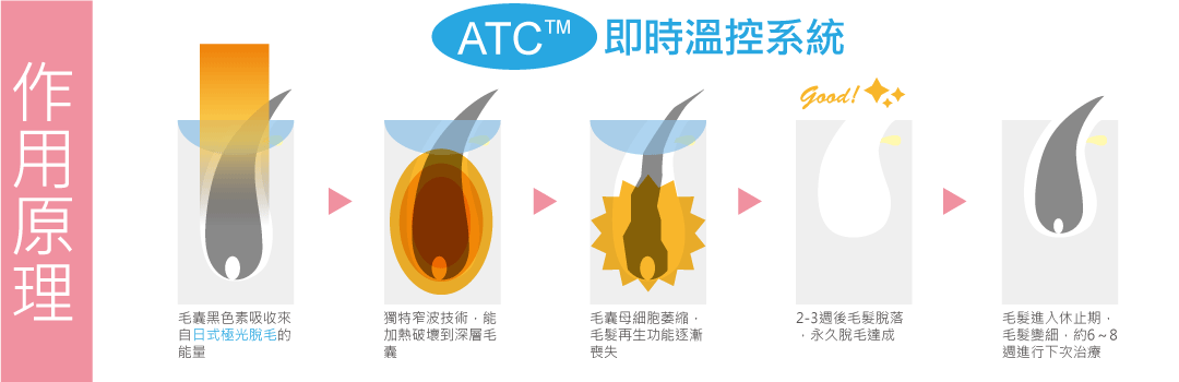 日式極光除毛作用原理-腋下除毛