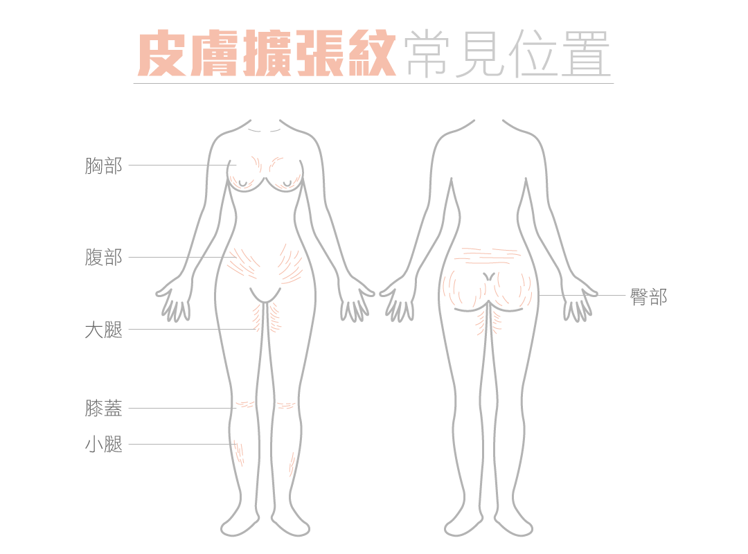 妊娠紋皮膚擴張紋生長範圍