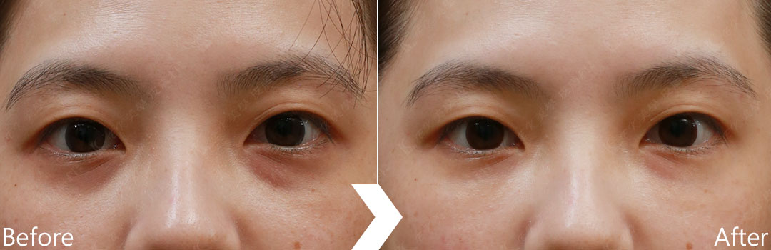 膠原蛋白植入劑案例-治療黑眼圈-04