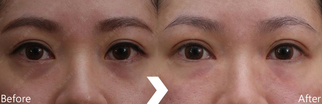 膠原蛋白植入劑案例-治療黑眼圈-07
