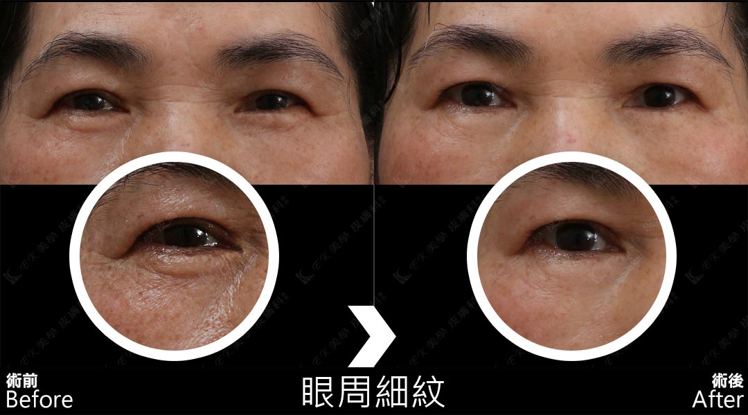 Tixel提可塑術前術後治療眼周細紋