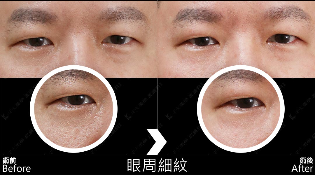 Tixel提可塑術前術後治療眼周細紋-03