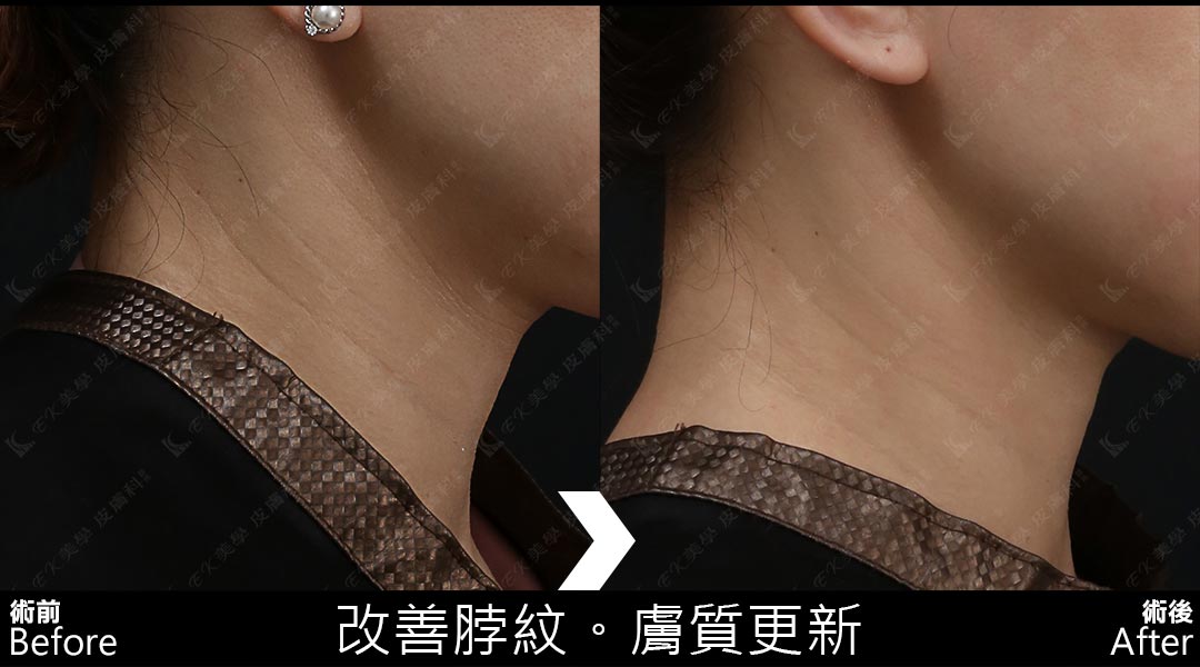 Tixel提可塑治療脖紋頸紋消除案例