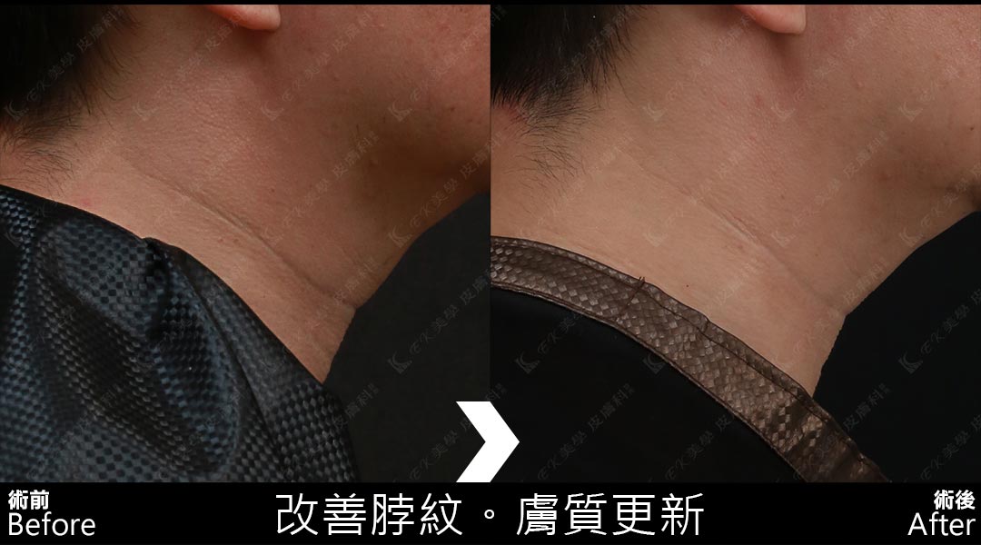 Tixel提可塑術前術後治療脖紋-02