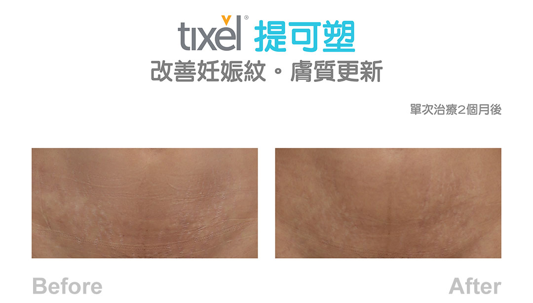 Tixel提可塑術前術後治療妊娠紋-03