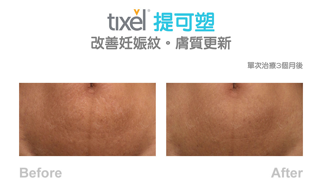 Tixel提可塑術前術後治療妊娠紋-04