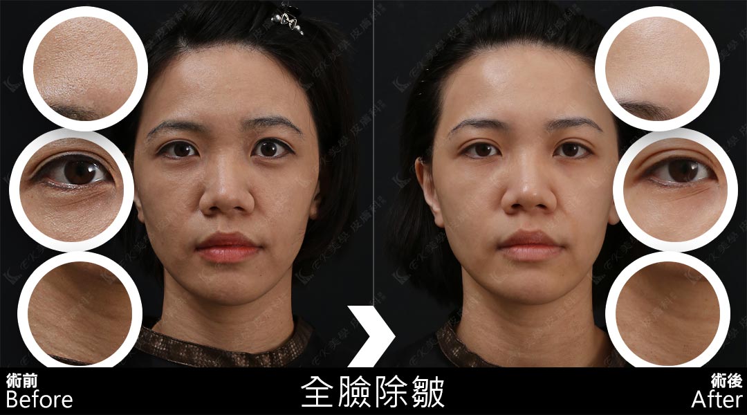 Tixel提可塑治療全臉膚質更新