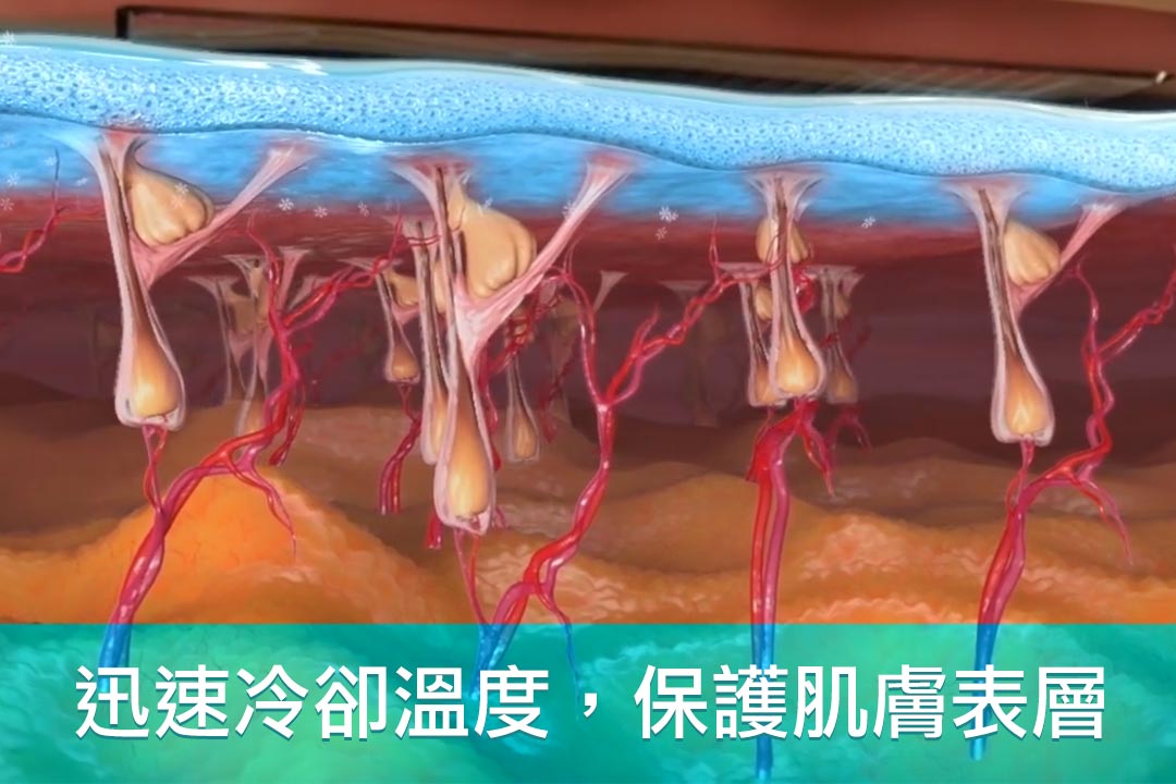 TRITON海神除毛雷射迅速冷卻溫度保護肌膚表層