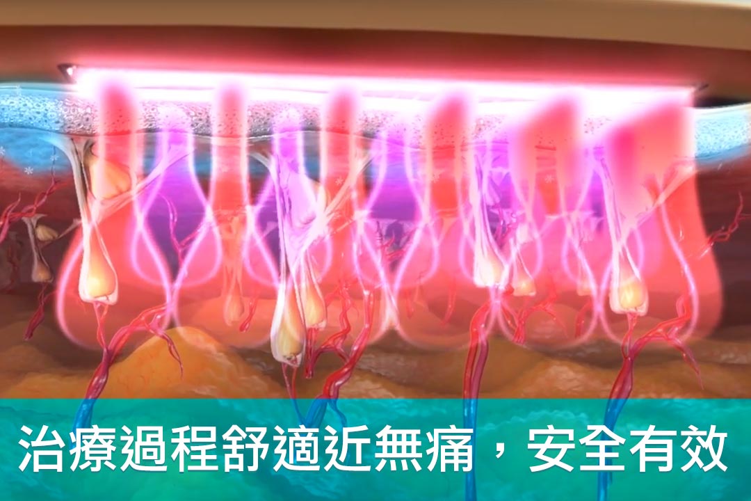 TRITON海神除毛雷射治療過程舒適近無痛安全有效 TRITON海神除毛雷射治療過程舒適近無痛安全有效