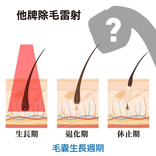 非海神除毛雷射作用技術