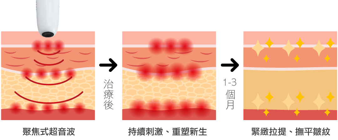 音波拉提治療過程-01