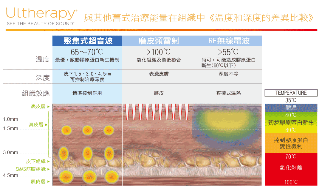 Ultherapy與其他舊式治療能量在組織中溫度和深度的差異比較圖