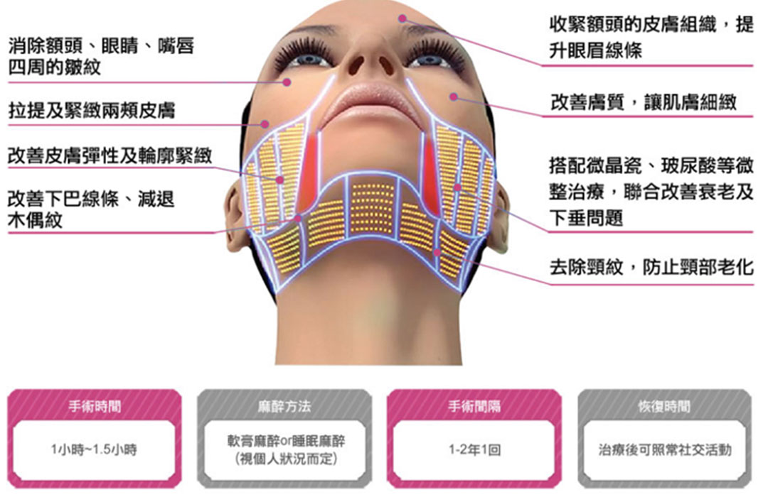 音波拉提(皮)適用部位說明圖示