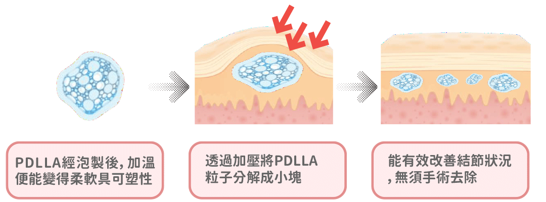 薇貝拉VIVABELLA特色｜不必擔心節結困擾