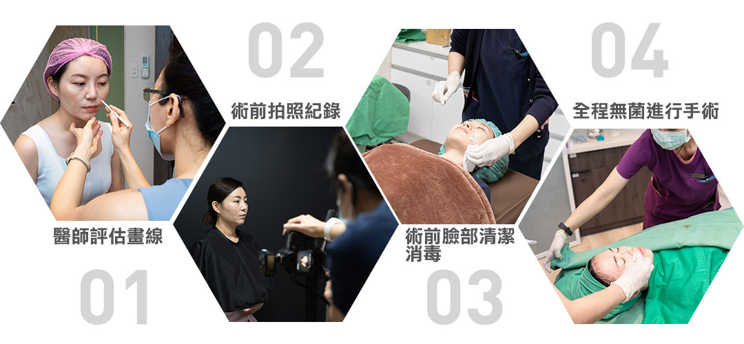 埋線拉提手術流程 埋線拉提手術流程