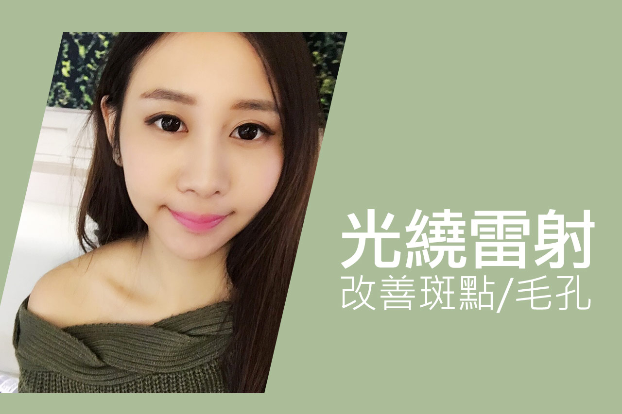 光繞雷射FB-案例分享