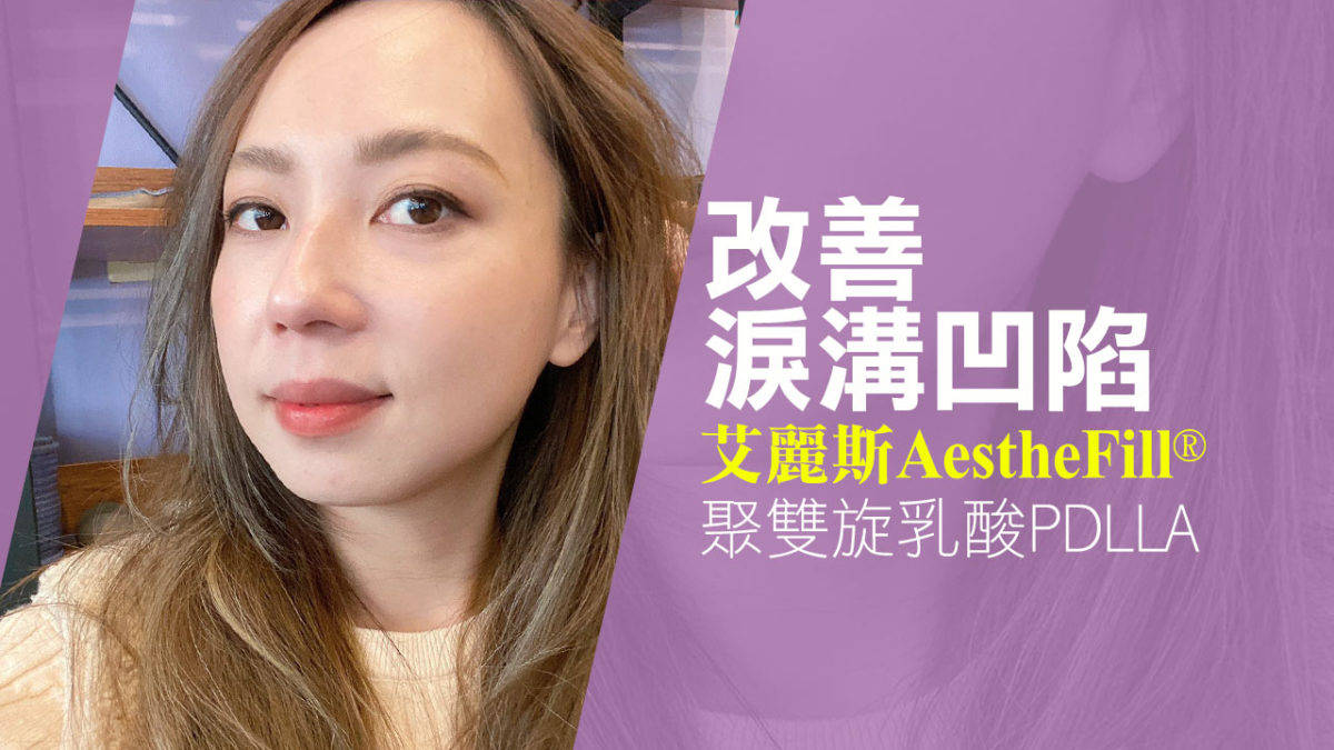 Aesthefill艾麗斯精靈針。改善淚溝凹陷