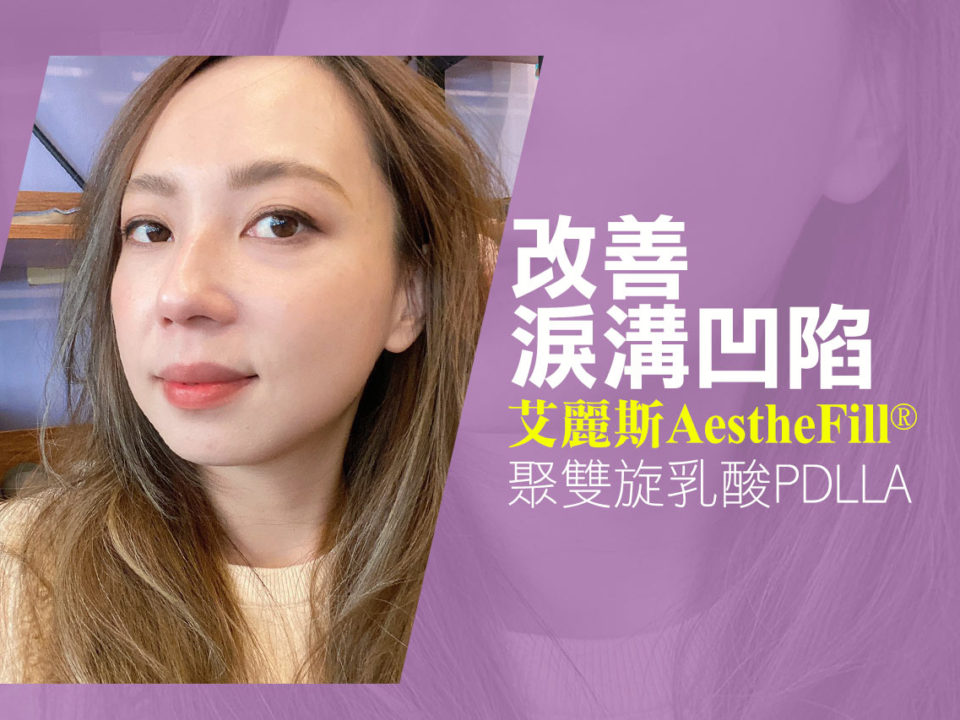 Aesthefill艾麗斯精靈針。改善淚溝凹陷