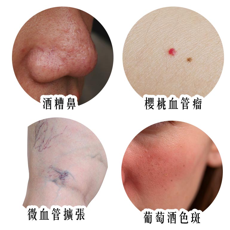 酒糟鼻|微血管擴張|櫻桃血管瘤