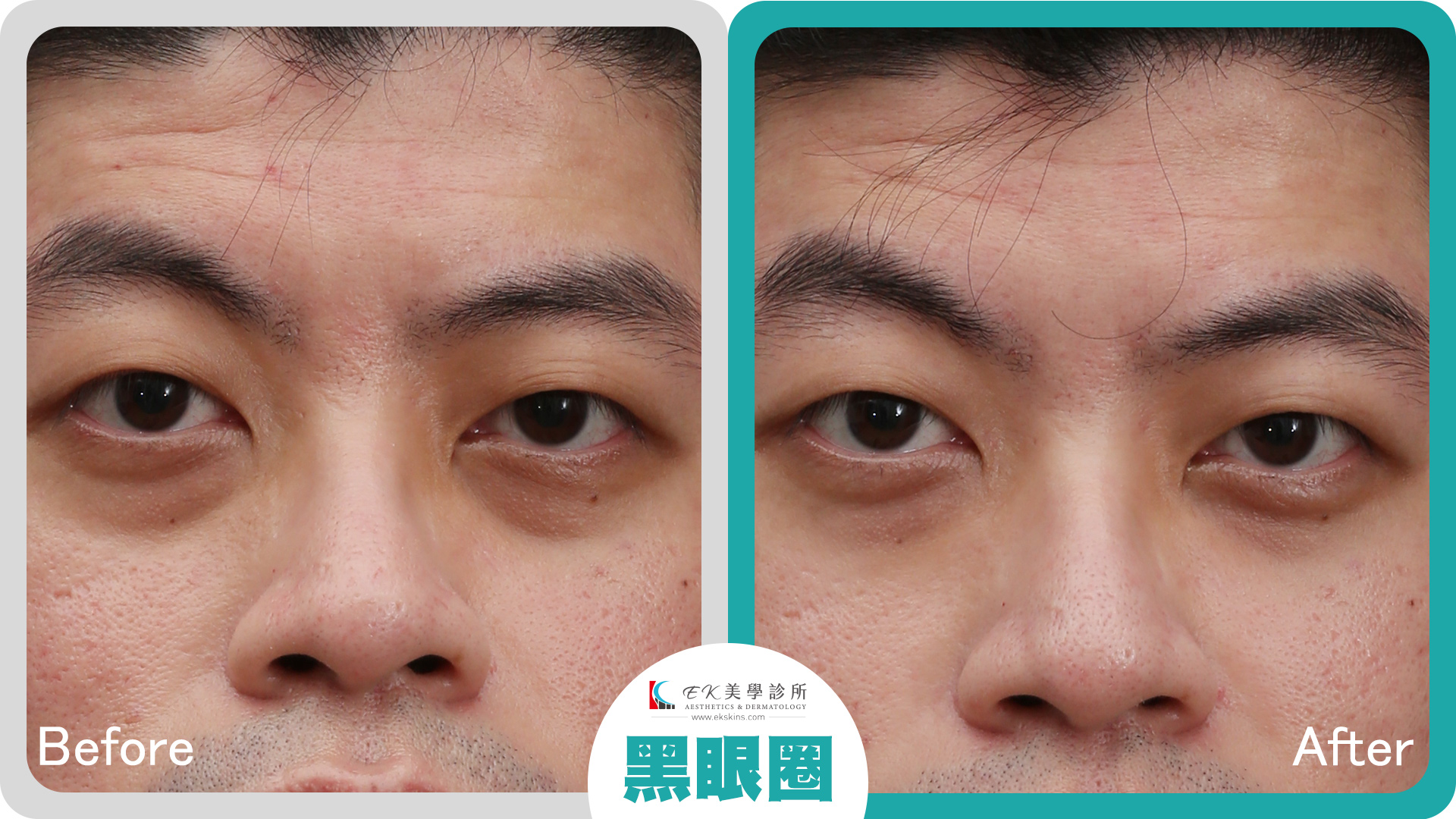 黑眼圈治療案例1