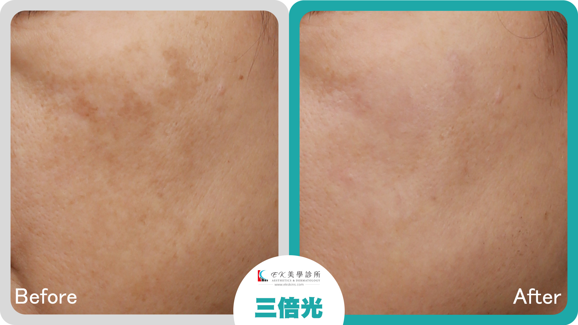 三倍光治療案例-06-改善敏感泛紅困擾