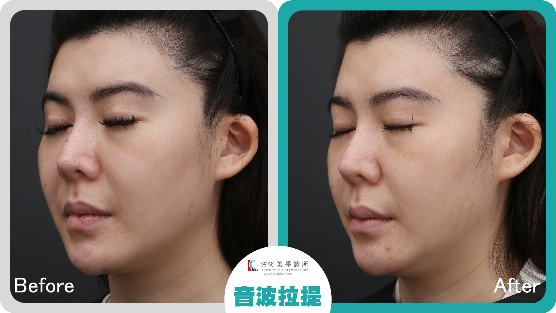 Liftera-V 立特拉聚焦超音波案例分享