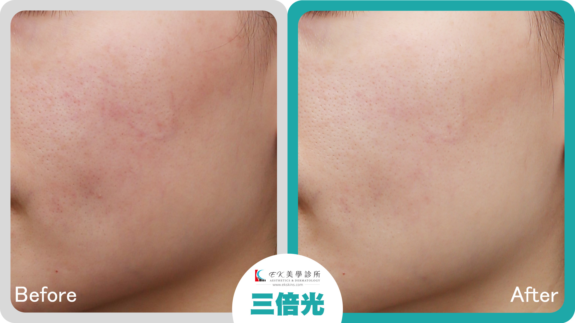 三倍光治療案例-04-改善泛紅痘印